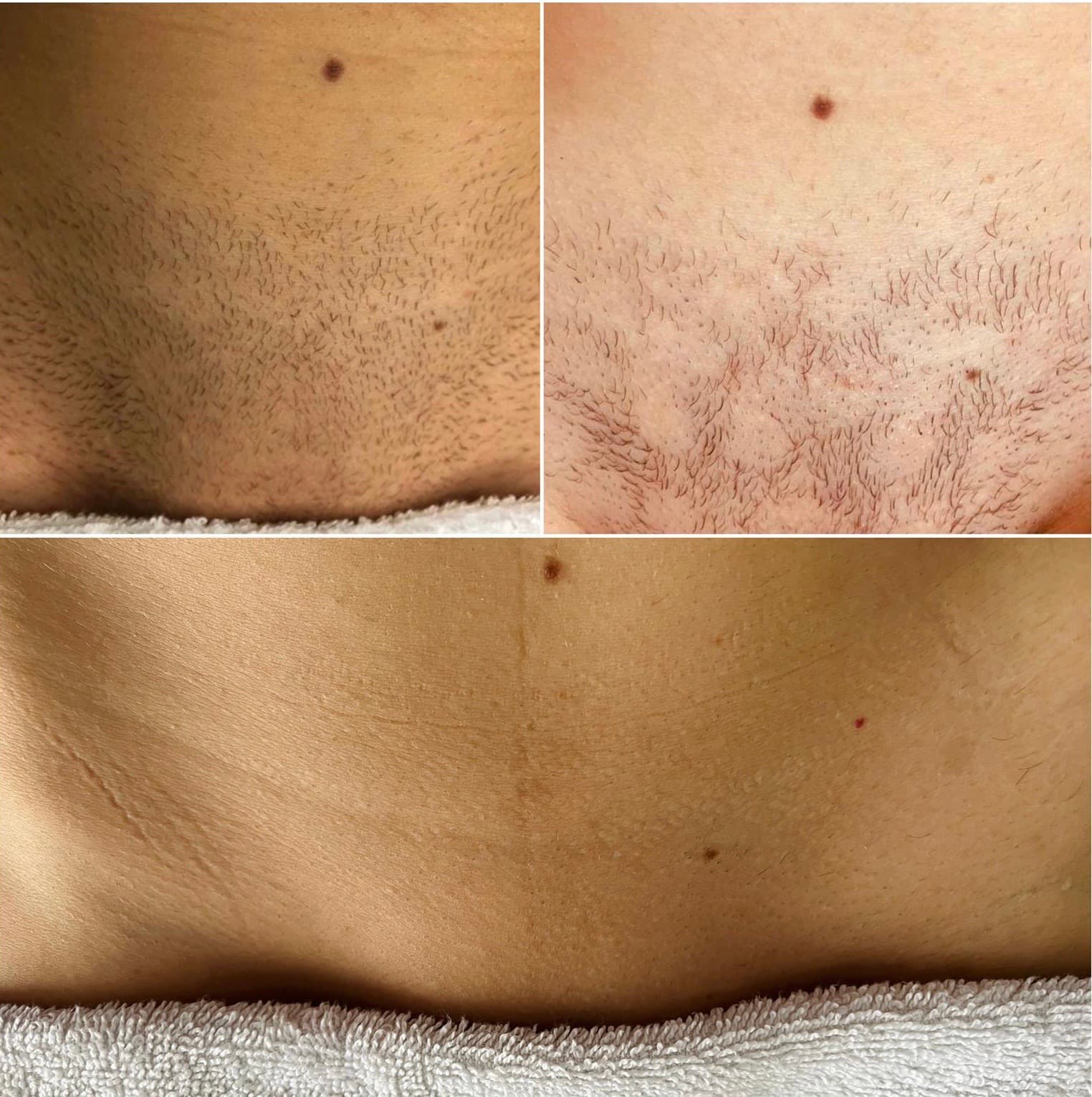 Inghinal - înainte și după