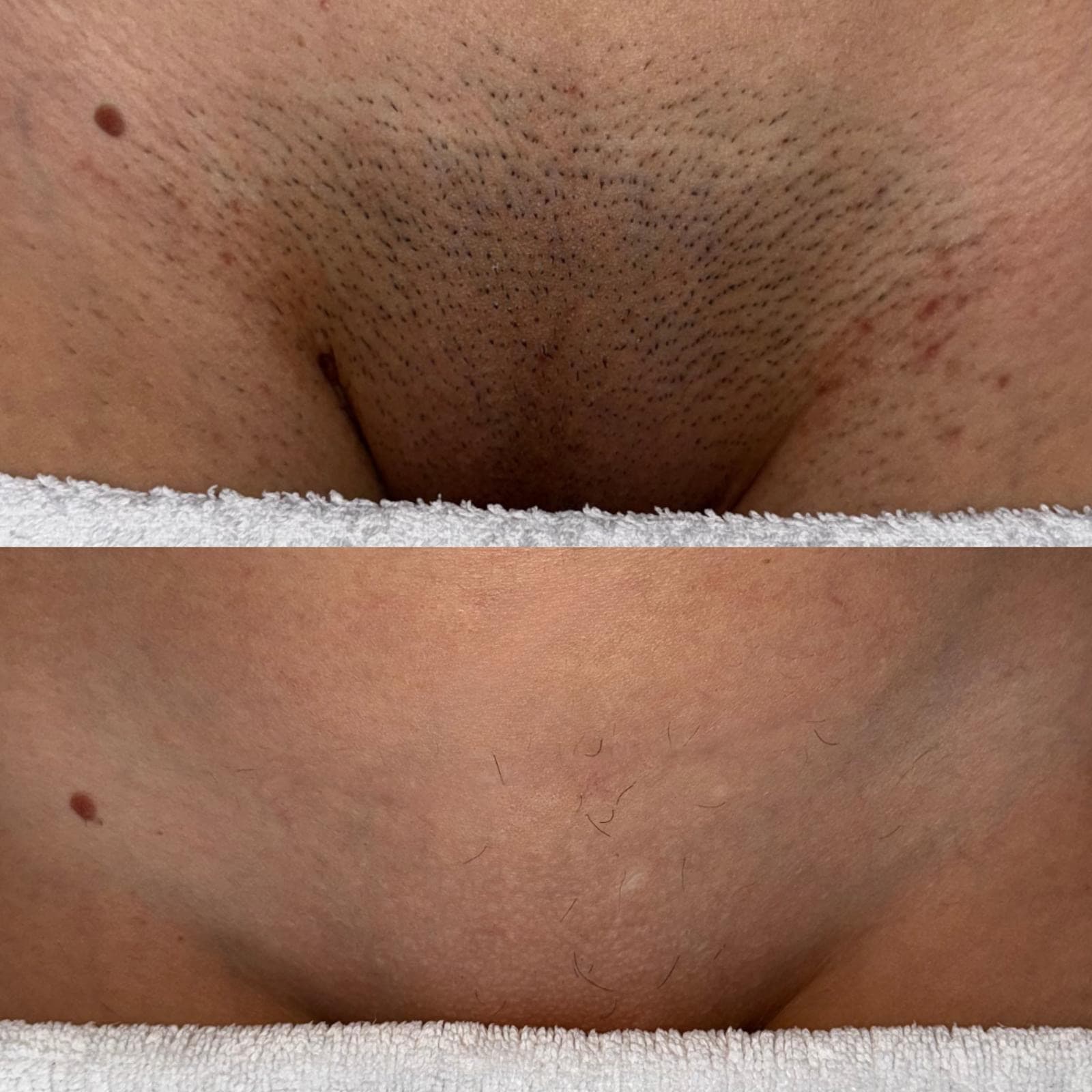 Inghinal - inainte si dupa