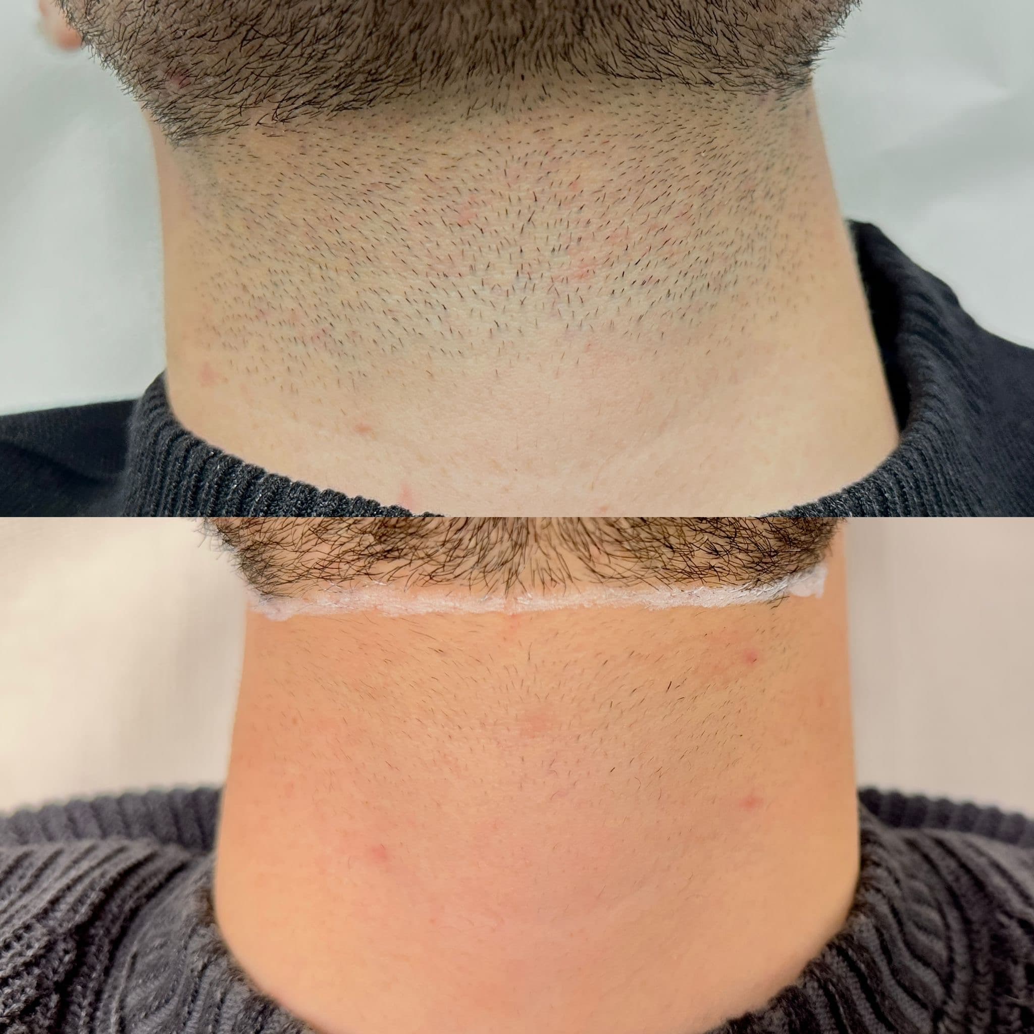 Gât - bărbat - înainte și după