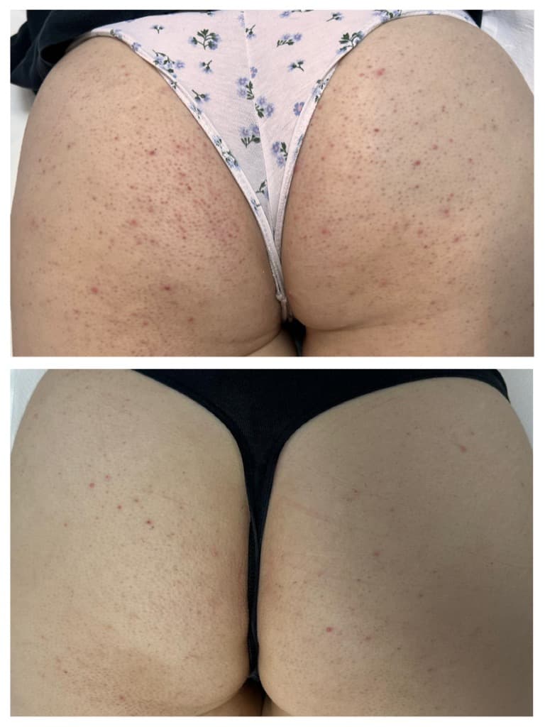 Tratarea foliculitei - inainte si dupa