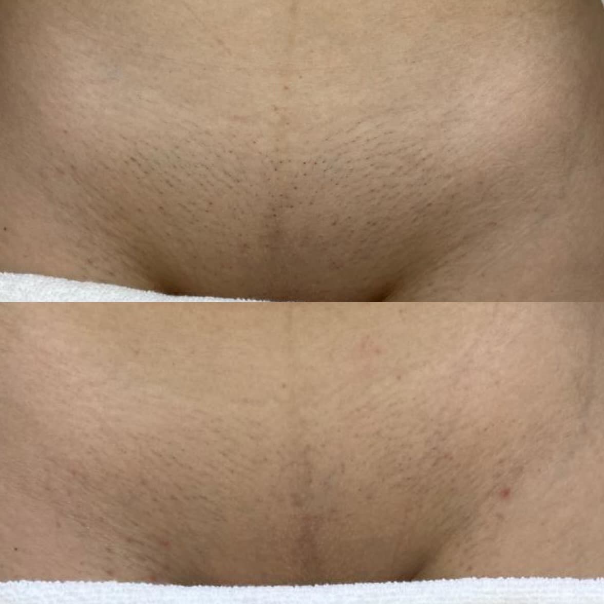 Inghinal - caz 2 - înainte și după