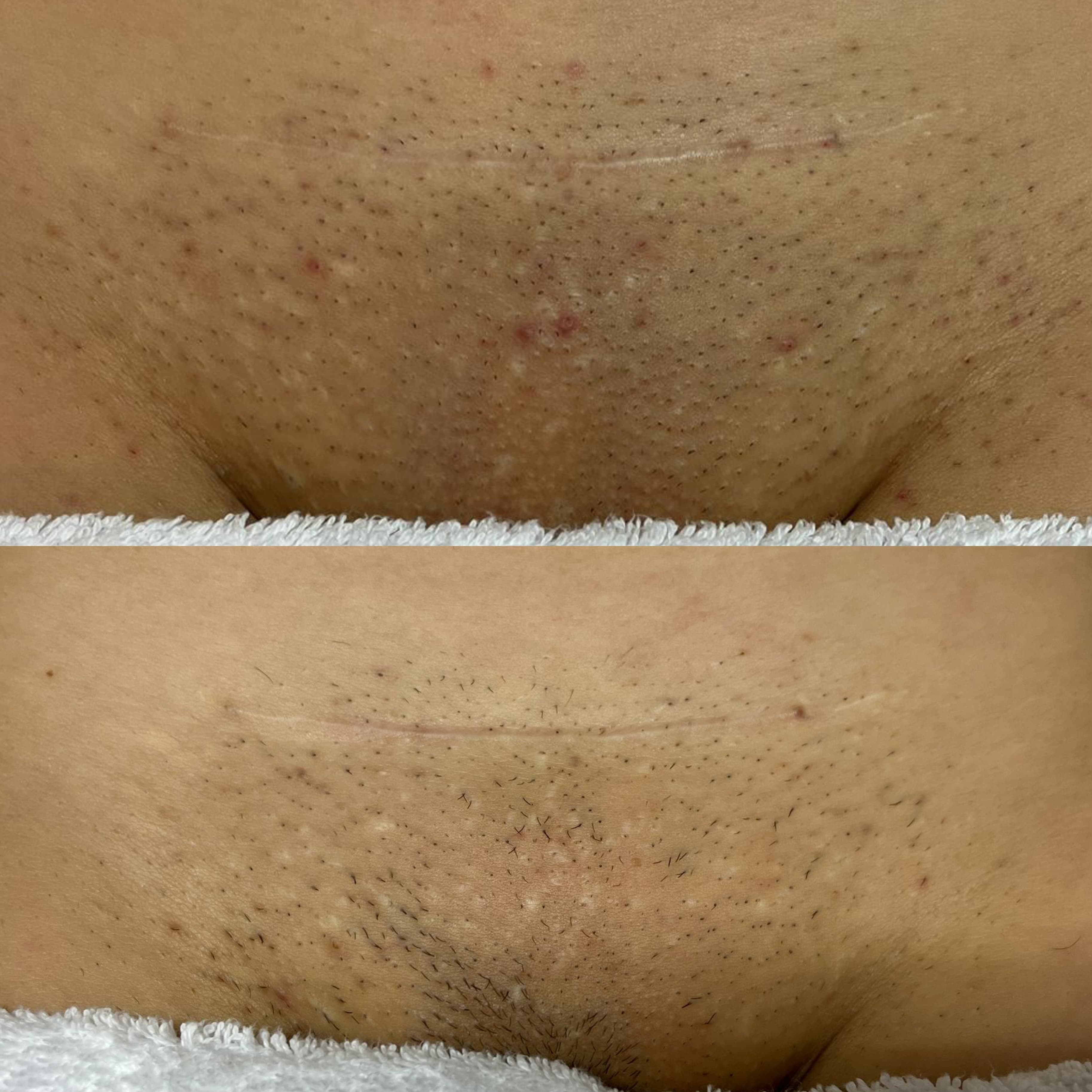 Inghinal - foliculită - înainte și după